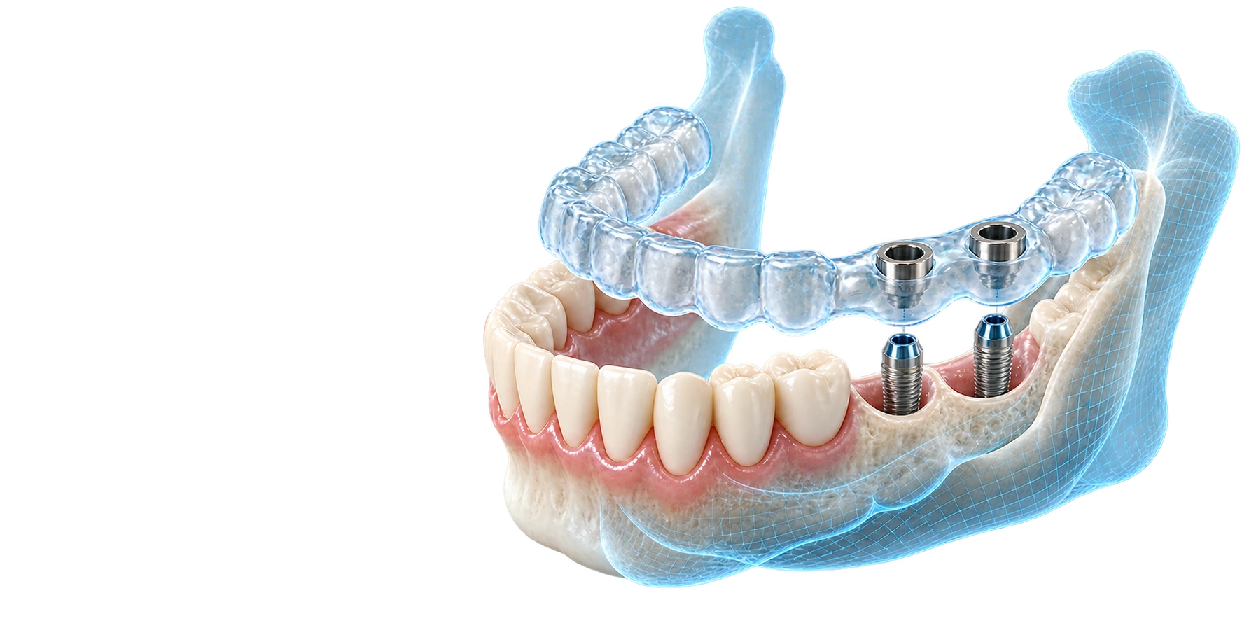 Guida chirurgica trasparente per l’intera arcata, con boccole metalliche sui siti implantari