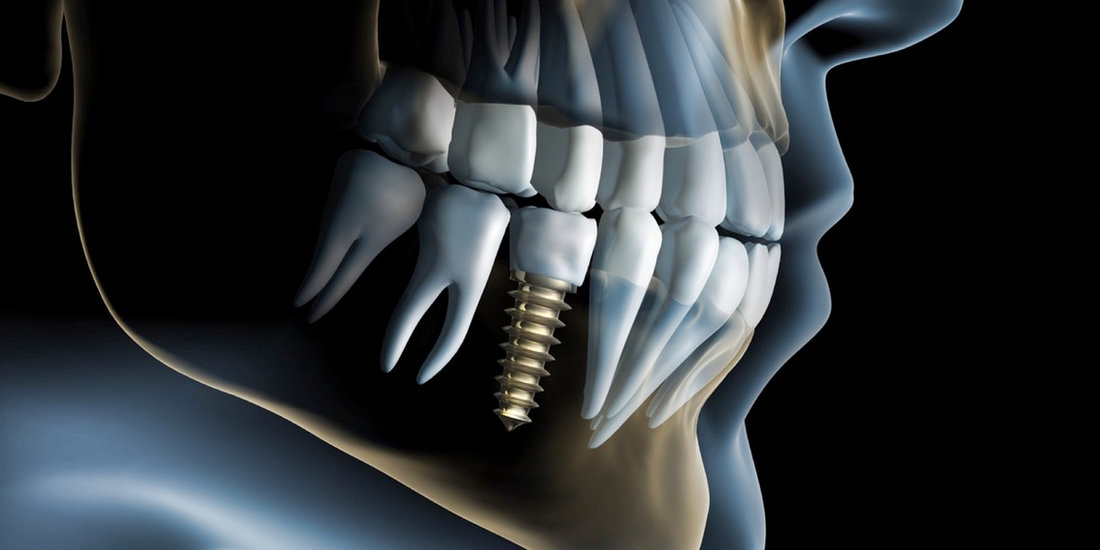 Rappresentazione di un impianto nell’arcata dentale.